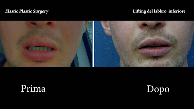 66. Elastic Lifting of the Lower Lip