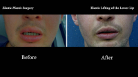 66. Elastic Lifting of the Lower Lip