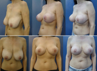 65. Elastic Mastopexy Under Local Anesthesia: Maintains Glandular Integrity, Increases the Upper Quadrant, and Prevents Ptosis